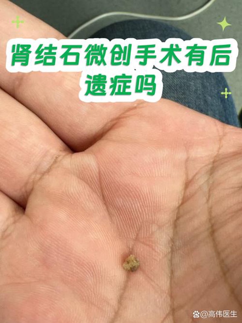 肾结石治疗