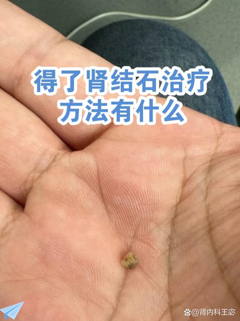泌尿结石微创治疗:了解常见问题与解决方案