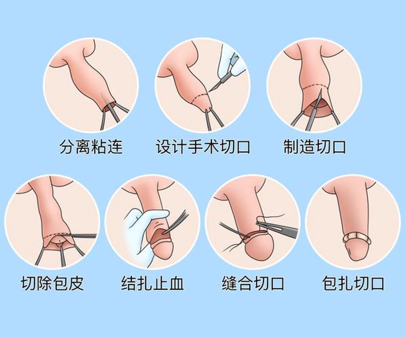 包皮手术